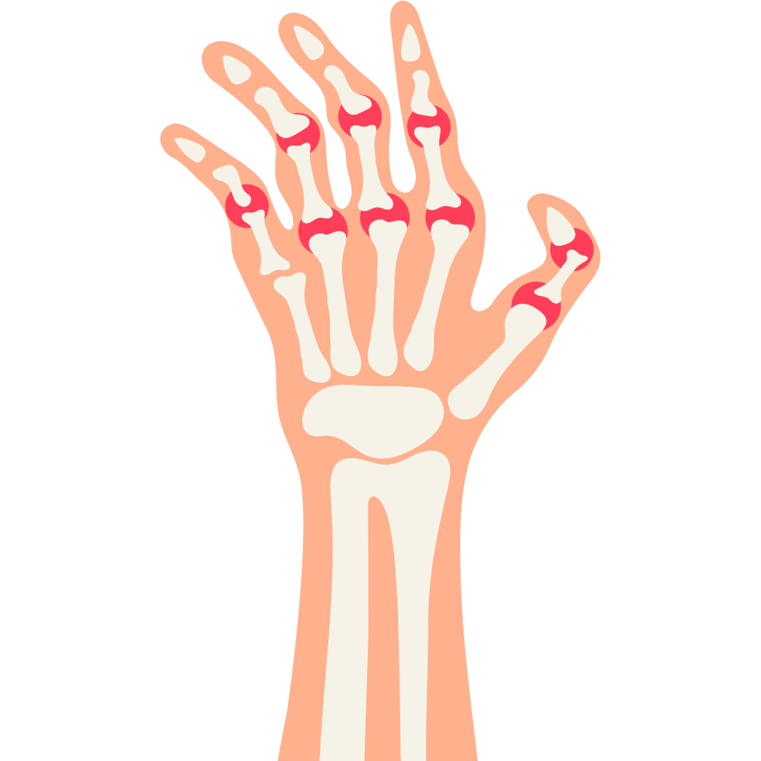  الذئبة الحمراء