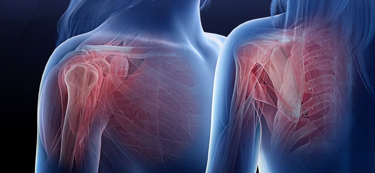 علاج تيبس الكتف بحقن العصب